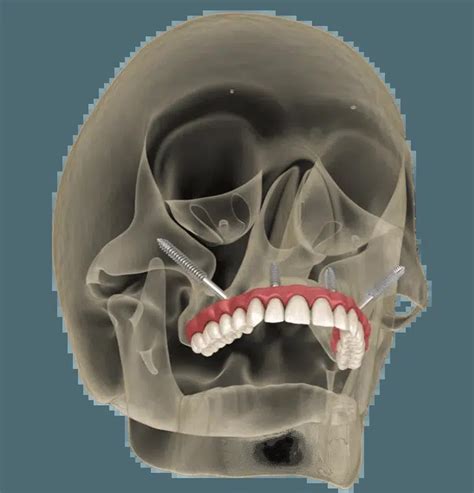dental bridge arvada|Iba pa.